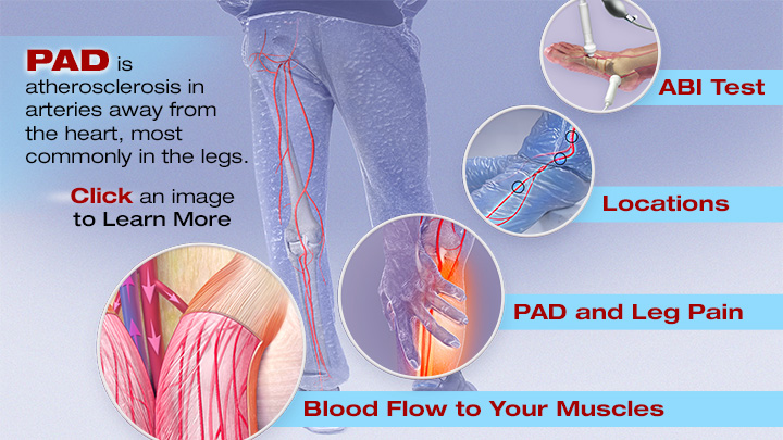 Pain Behind the Knee and Calf? What Causes it and how do I get help? :  Peachstate Advanced Cardiac & Endovascular: Board Certified Interventional  Cardiologists